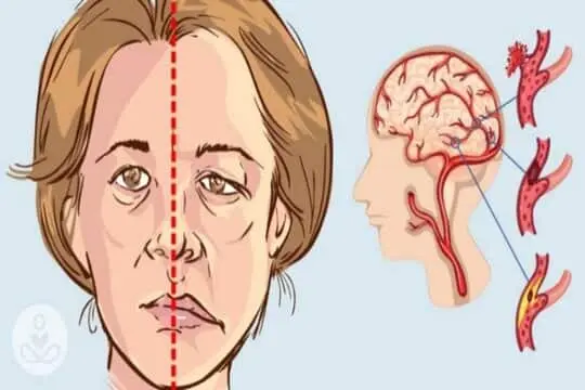 Cum-putem-restabili-mișcarea-și-vorbirea-după-un-accident-vascular-cerebral